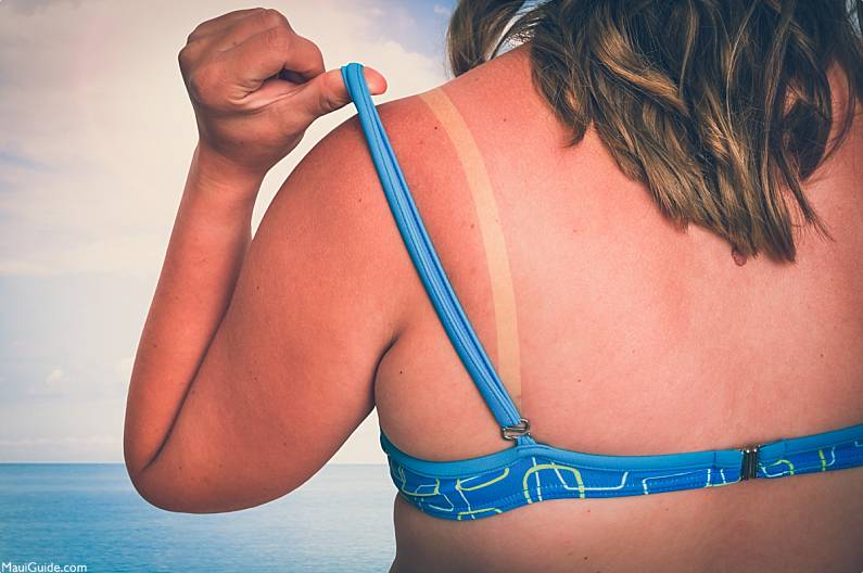 Maui Tourist Mistakes Sunburn